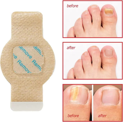 Nighttime Renewal Fungal Nail Patches