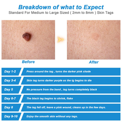 2 In1 Painless Auto Skin Tag Mole Removal Kit